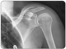 An x-ray may be taken to rule out a bones spur, hooked acromion, or calcification in the bursa as a cause of the bursitis.