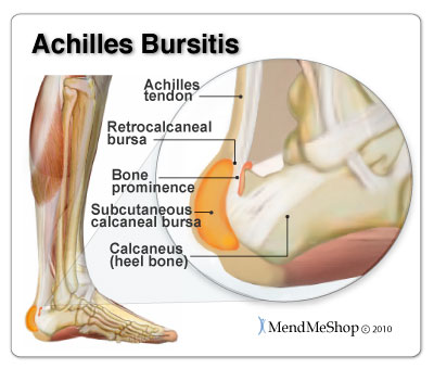 Achilles Bursitis pain and inflammation can be treated naturally conservative home treatments