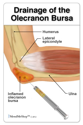 Drainage of elbow (olecranon) bursitis