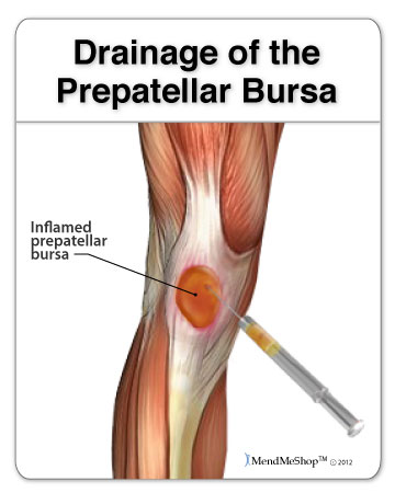 Recovery from draining your knee bursitis.