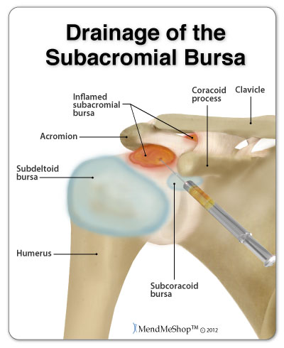 Drainage of shoulder (subacromial) bursitis