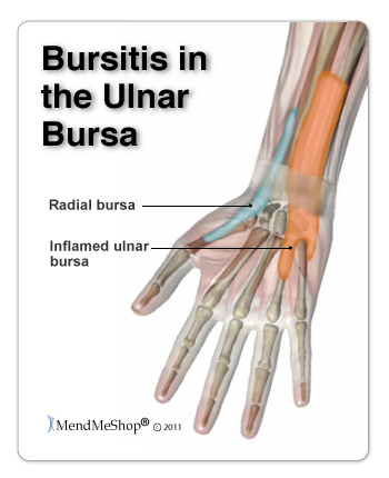 Where are bursae in the hand or wrist?