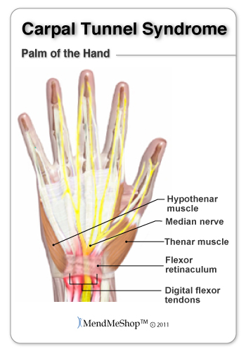 A doctor visit is always recommended, to tell you what type of wrist pain you have, bursitis or tendonitis
