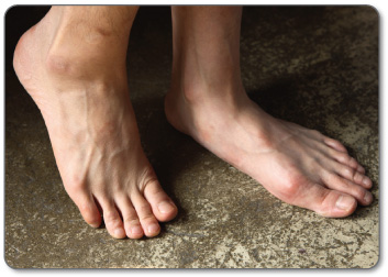 Conservative treatment methods are the best way to treat foot bursitis of any kind.