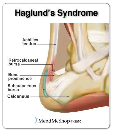 Haglund's Syndrome causes excess rubbing at the back of the heel, often leading to Achilles Bursitis and Achilles Tendonitis.