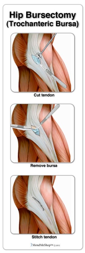 Removal of the trochanteric bursa, hip bursectomy.