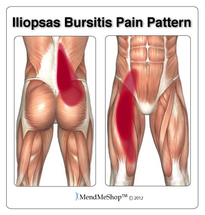 Recovering from iliopsoas (hip) bursitis.