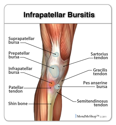 Infrapatellar bursitis causes pain in the knee