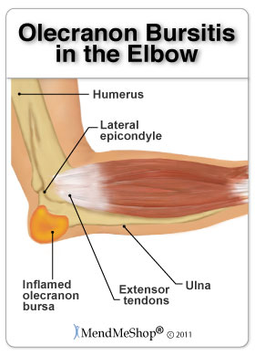 olecranon bursitis in the elbow