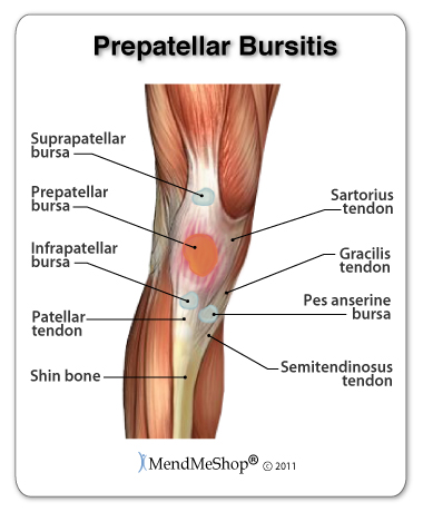 Infrapatellar bursitis causes pain in the knee.
