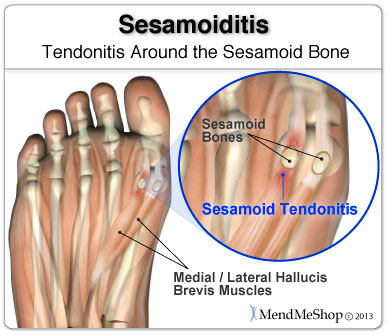 Injury to the tissue holding small sesamoid bones can case foot pain.