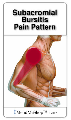 Subacromial Bursitis pain pattern.